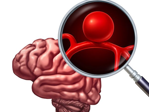 Neurologo-en-CDMX-Experto-en-Aneurisma-Cerebral-Dra-Lorena-Cuellar-especialista-en-Neurologia-en-Mexico-v001-compressor