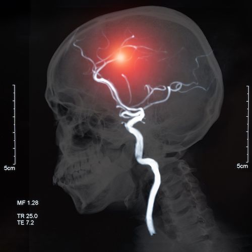 Neurologo-en-CDMX-Experto-en-Aneurisma-Cerebral-Dra-Lorena-Cuellar-especialista-en-Neurologia-en-Mexico-v002-compressor